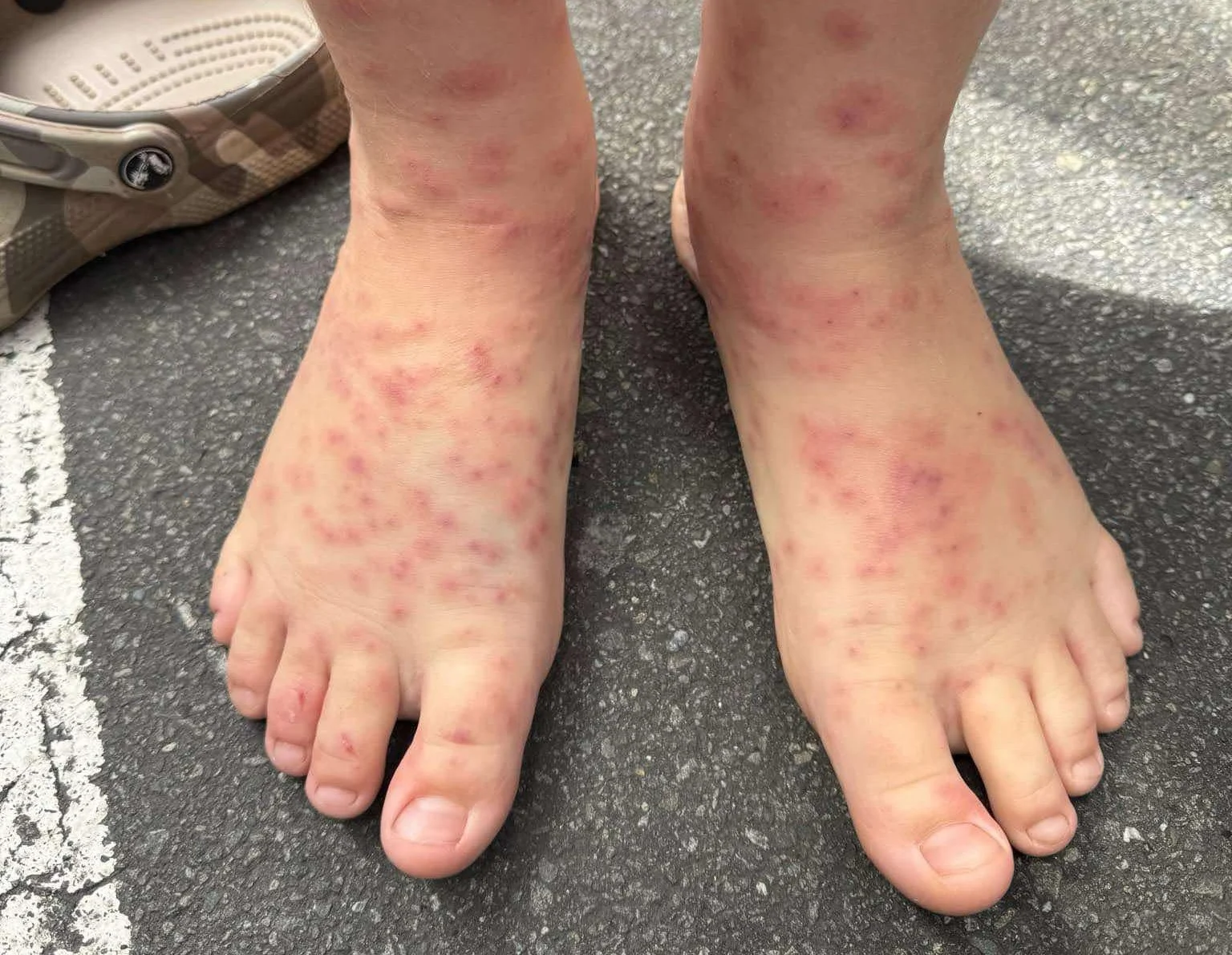 Sea lice warning after ‘horrific’ bites